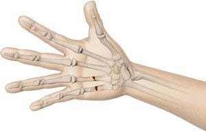 Hand and Finger Fractures